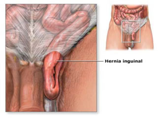 Inguinal Hernia: Symptoms, Causes & Surgical Treatment - Tua Saúde